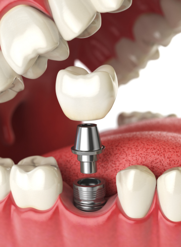 Dental implant treatment