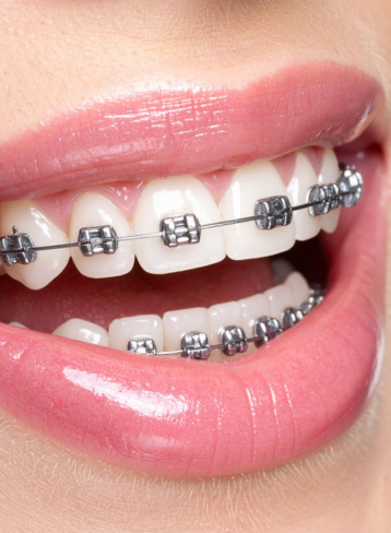 Orthodontics braces and aligners