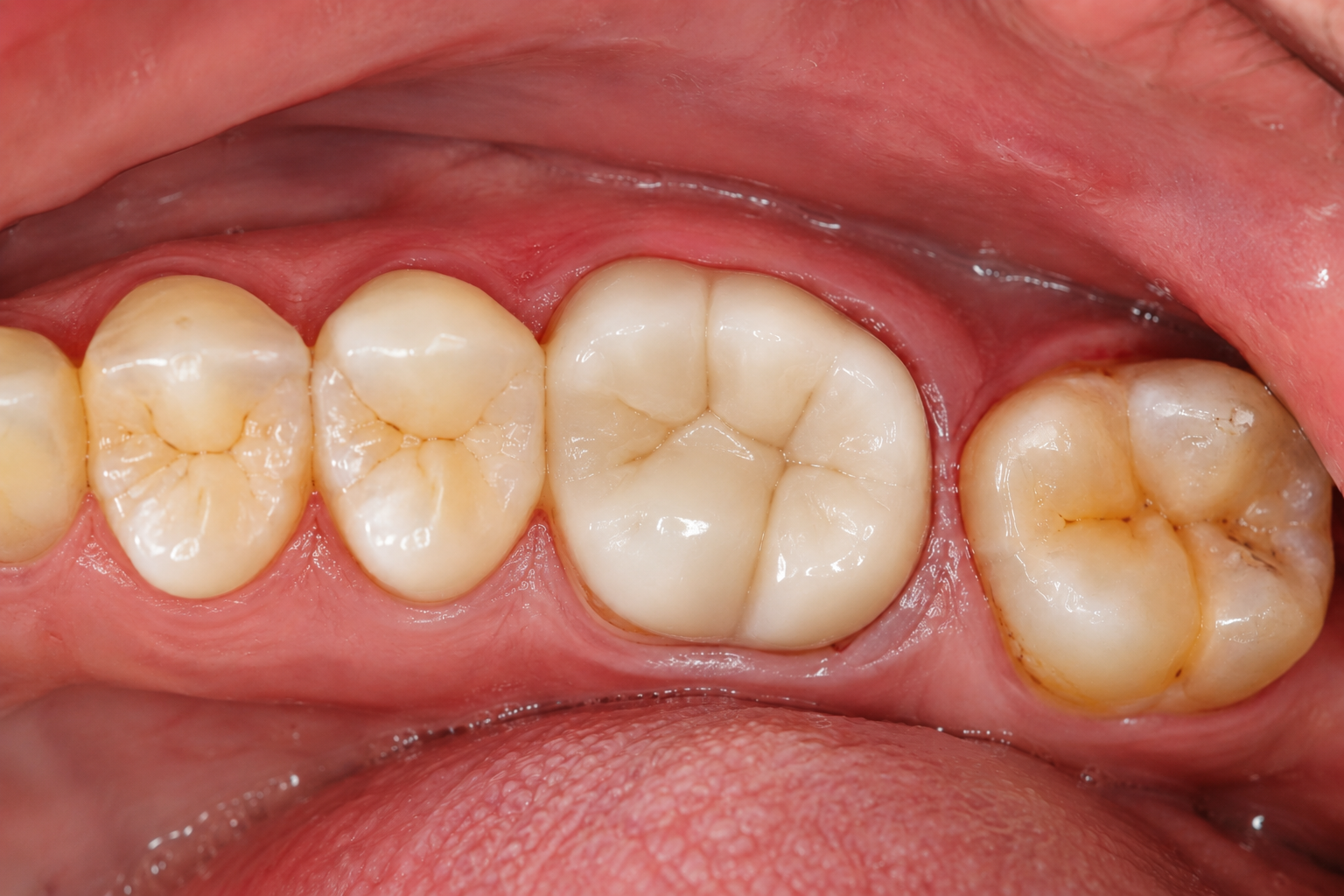 Root Canal Treatment Result