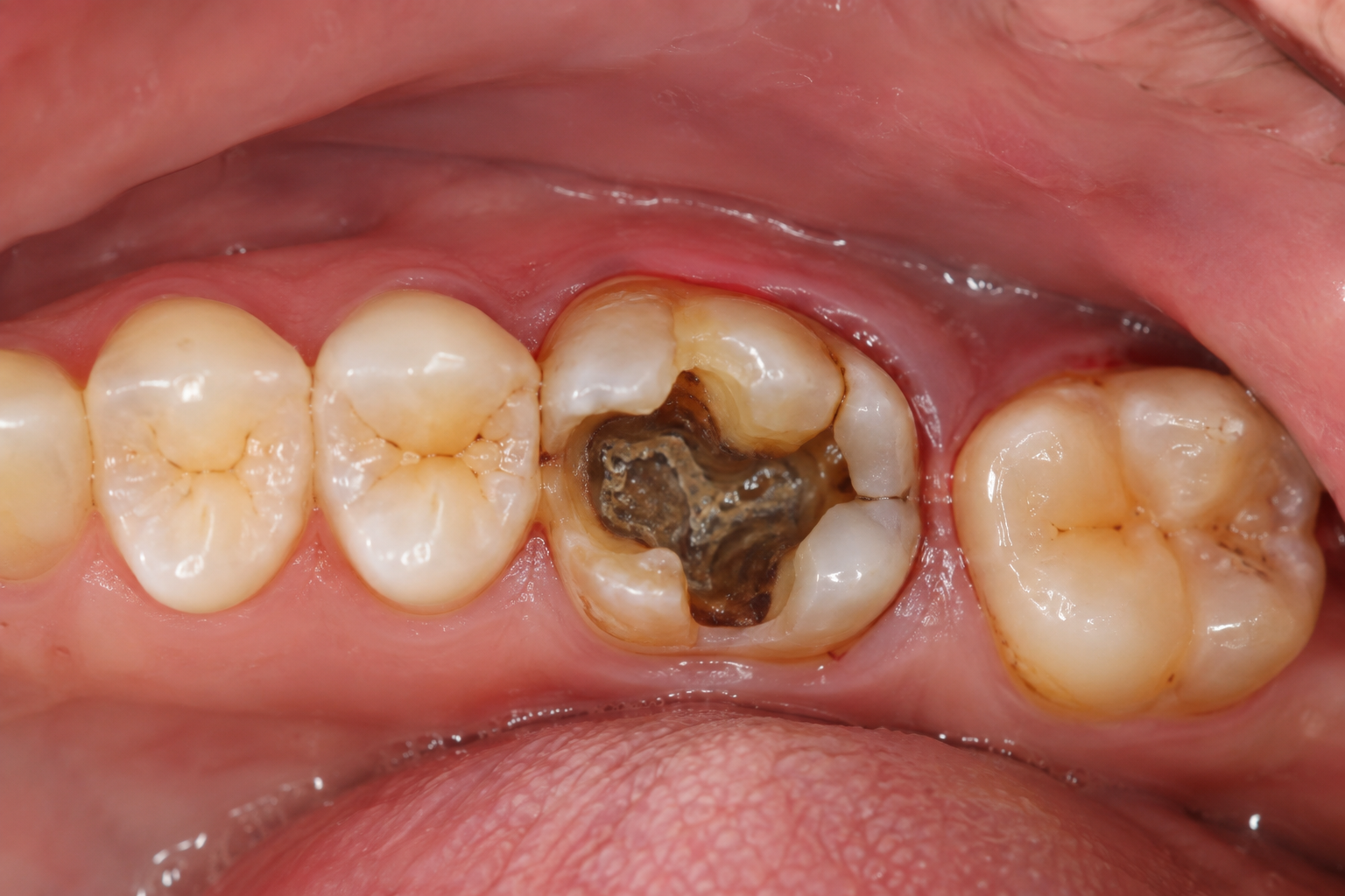 Root Canal Treatment Condition