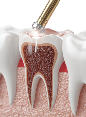 Root canal treatment