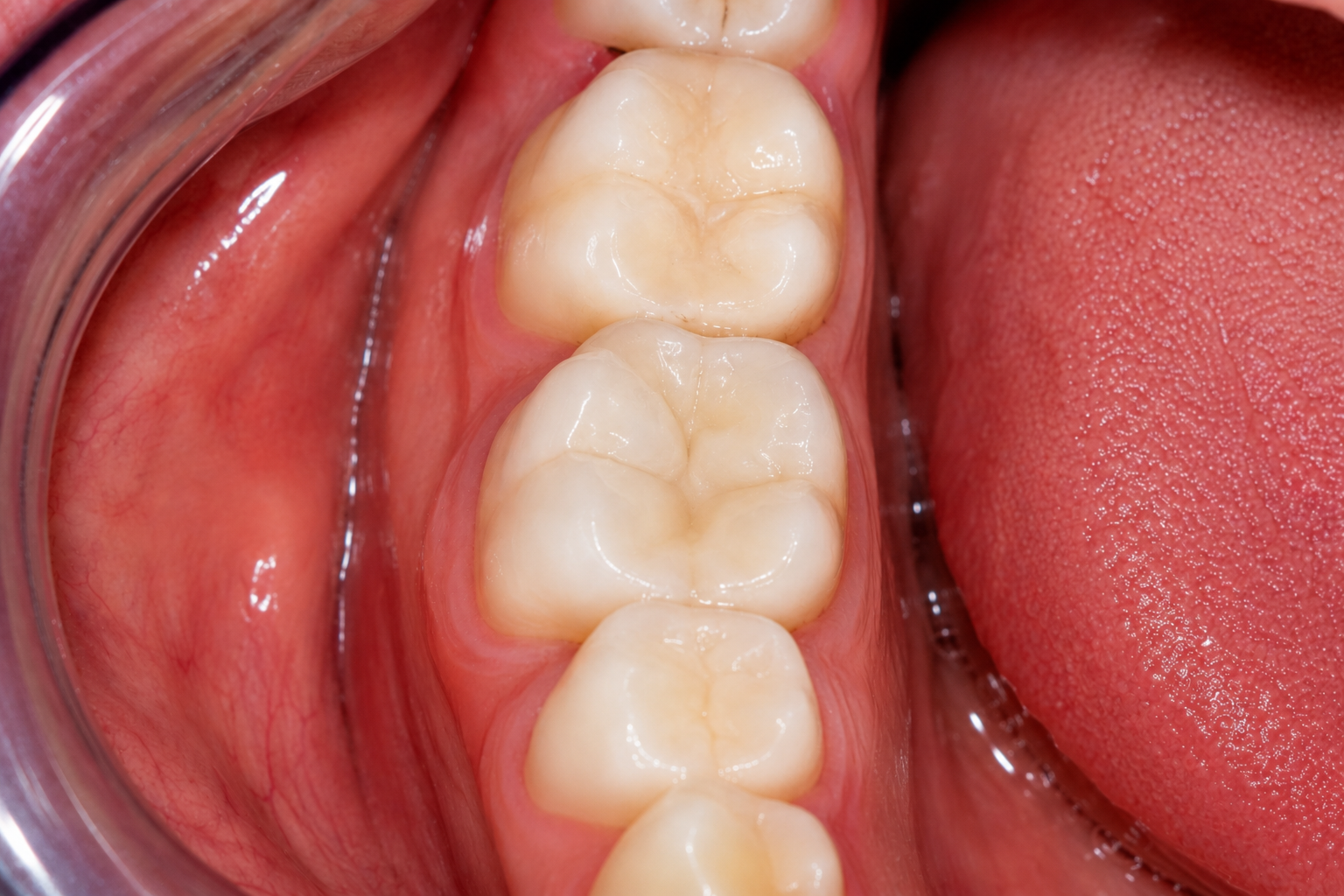 Teeth Coloured Fillings Result