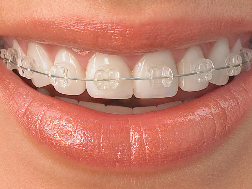 Ceramic tooth-colored braces close-up