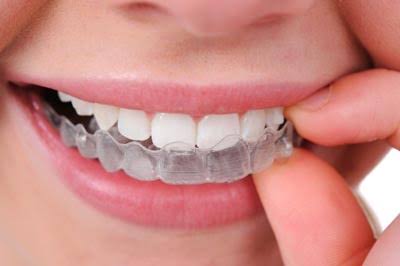 Dental professional holding a clear aligner tray