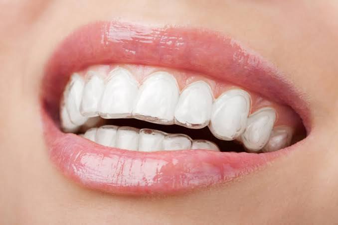 Clear aligner tray over a smile