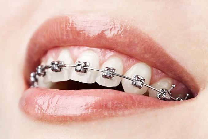 Damon self-ligating braces close-up