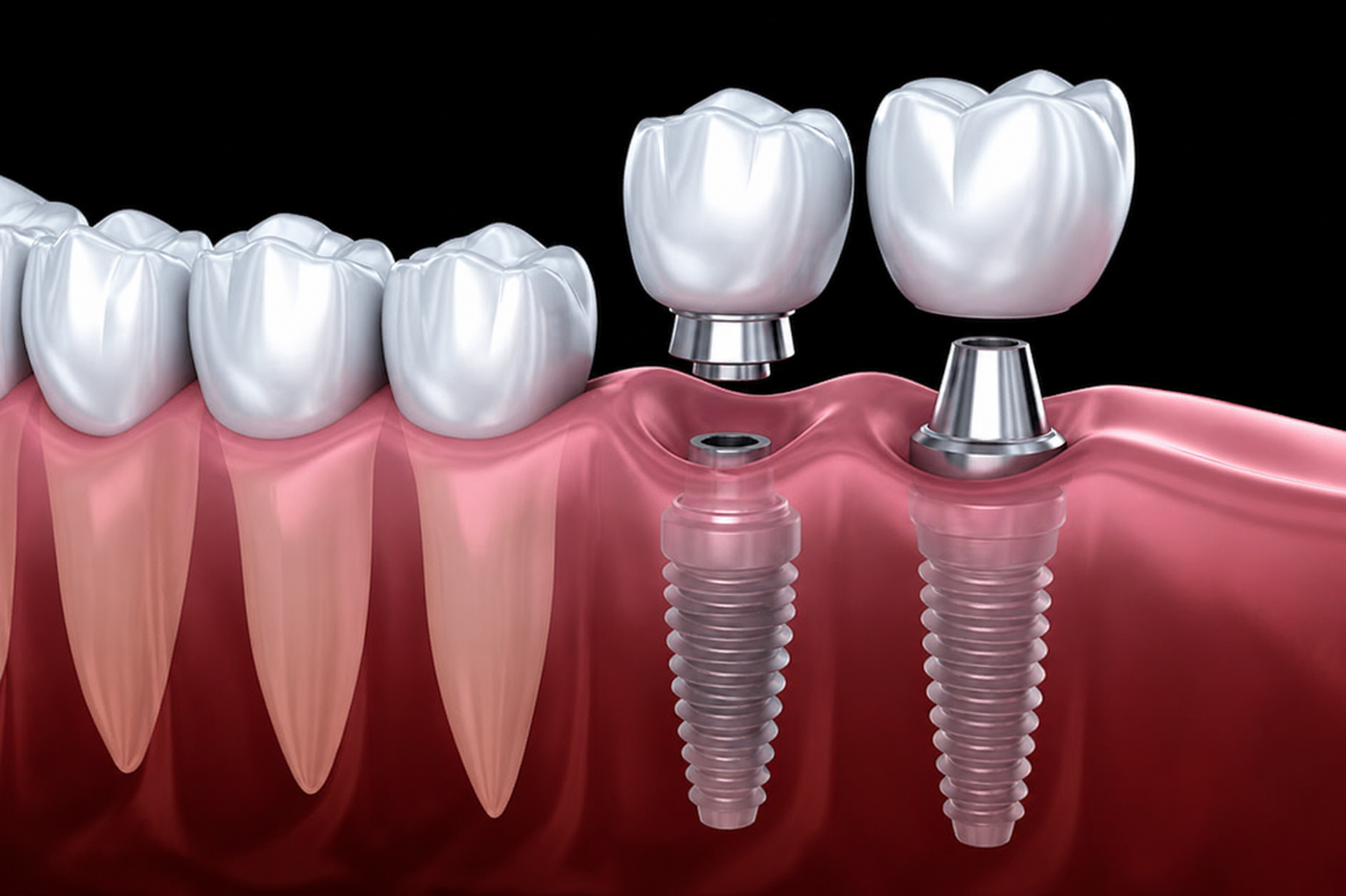 Illustration of a titanium dental implant set into the jawbone beside natural teeth