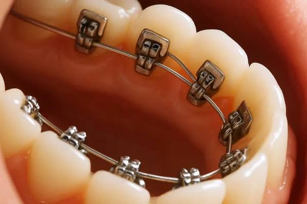 Lingual braces fitted to the back of the teeth