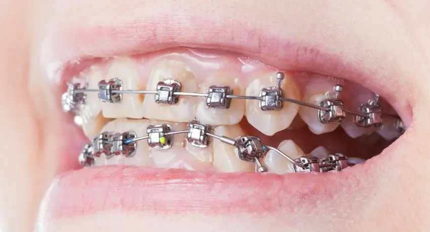 Self-ligating braces with sliding wire mechanism