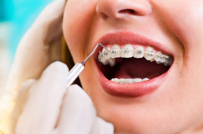 Close-up smile showing traditional metal braces