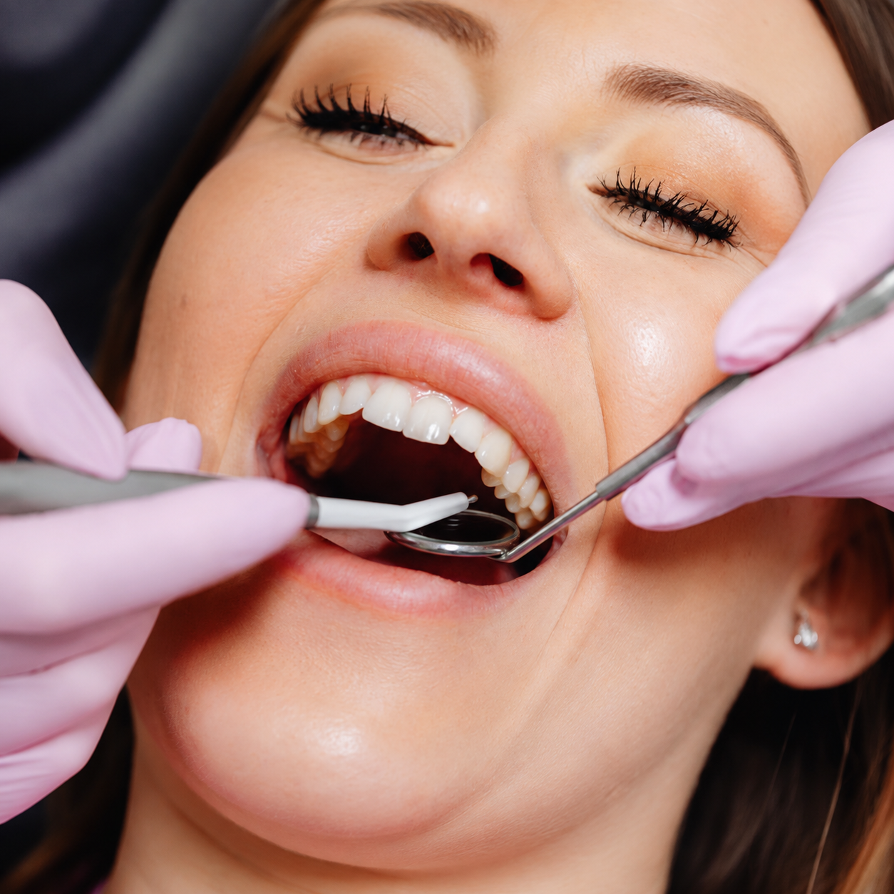 Illustration of a composite resin filling being applied to a tooth