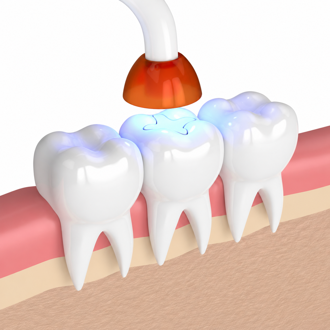 Dentist applying a tooth-colored filling during a patient checkup