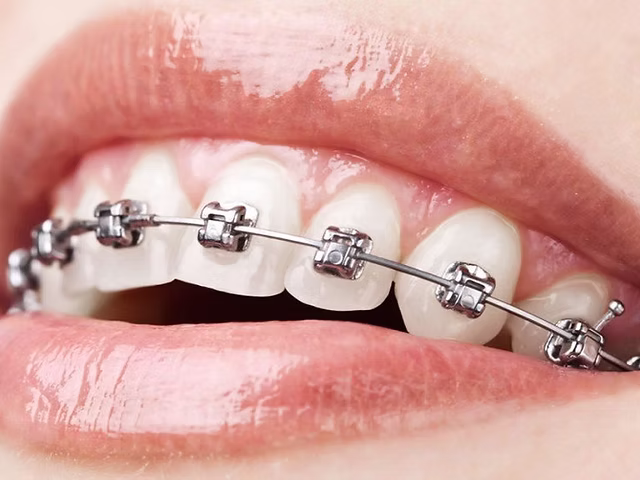 Traditional metal braces close-up
